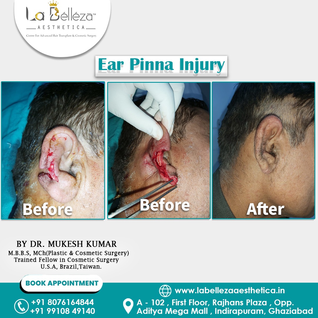 Ear_Pinna_Injury.jpeg