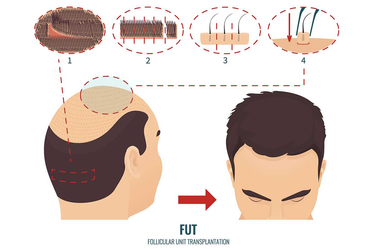 FUT Hair Transplant