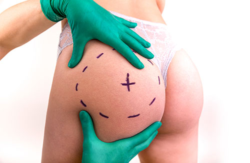Butt  Enlargement  Surgery