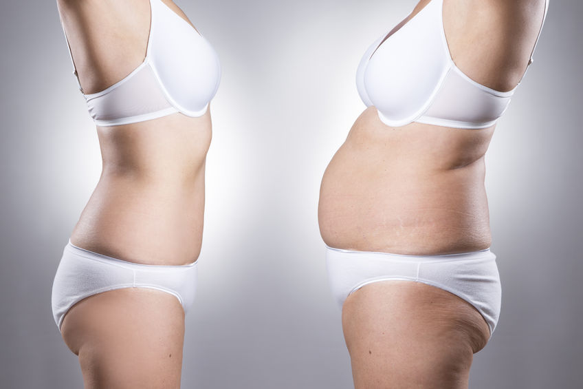 Post Pregnancy Mommy Makeover