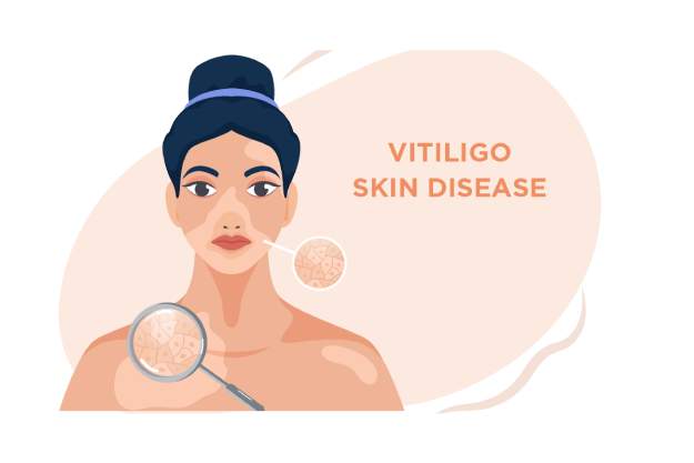 Vitiligo treatment